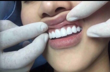 Hỏng răng vĩnh viễn, mất cả hàm nhai cơm vì bọc răng sứ kém chất lượng